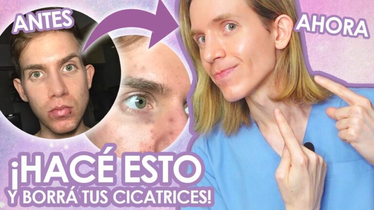 Mejora de la Piel con Acné: Tratamientos Dermatológicos Efectivos