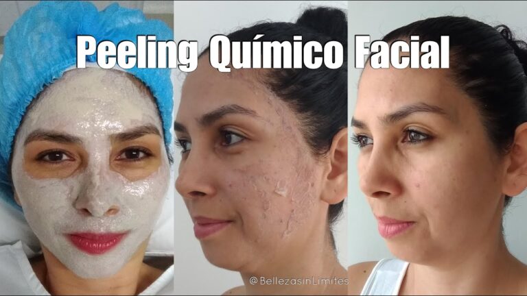 Piel Radiante: Beneficios del Peeling Qu&iacute;mico