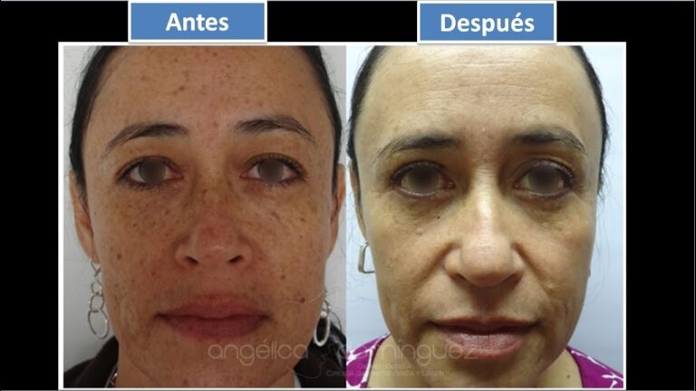 Elimina las manchas con tratamientos especializados eficaces