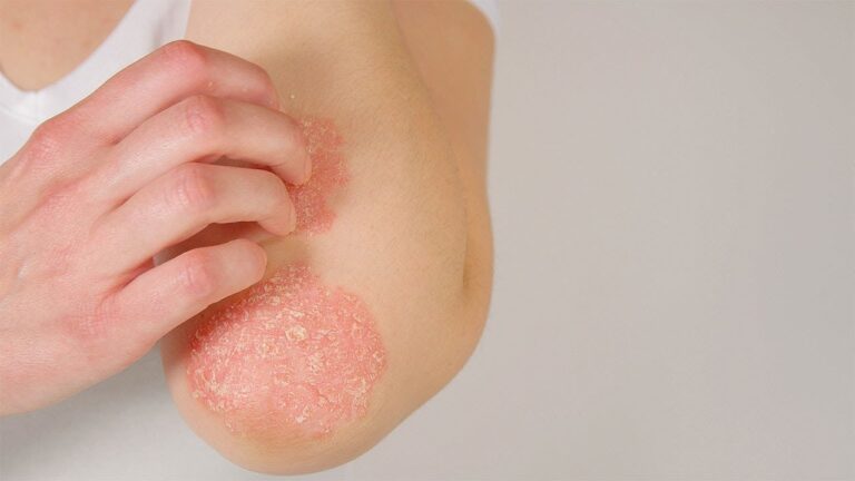 Tratamientos Efectivos para la Psoriasis en la Piel