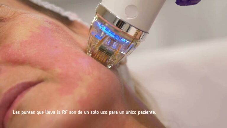 Revitaliza tu piel: Radiofrecuencia facial para una apariencia m&aacute;s joven