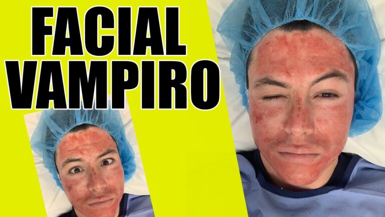 Piel Radiante: Beneficios de la Terapia de Plasma