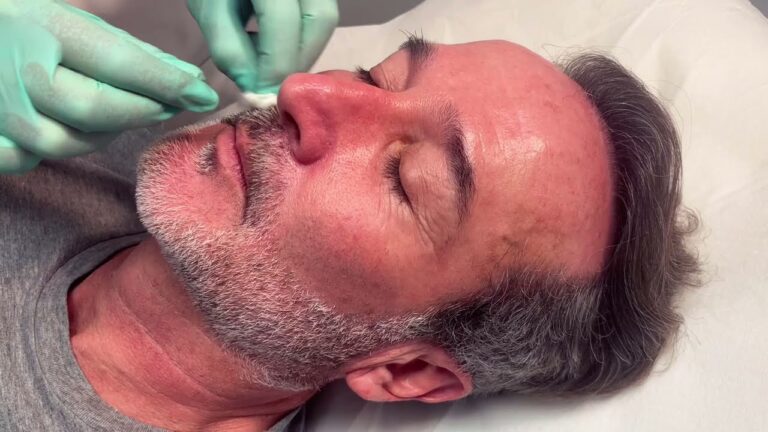 Renovación Cutánea: Beneficios de la Mesoterapia Facial