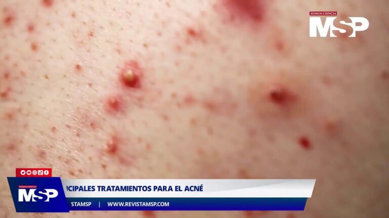 Métodos Efectivos de Tratamiento para el Acné Facial