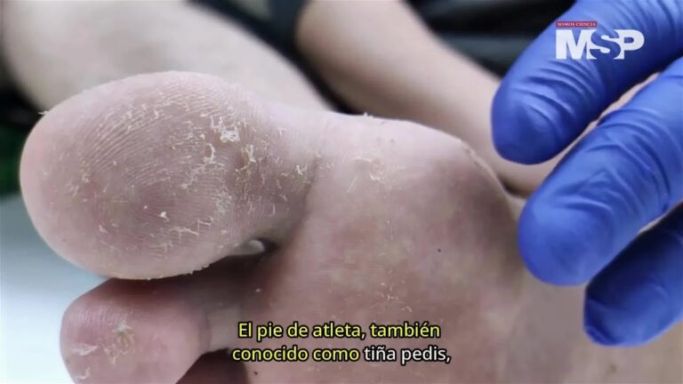 Remedios Naturales Efectivos contra el Pie de Atleta