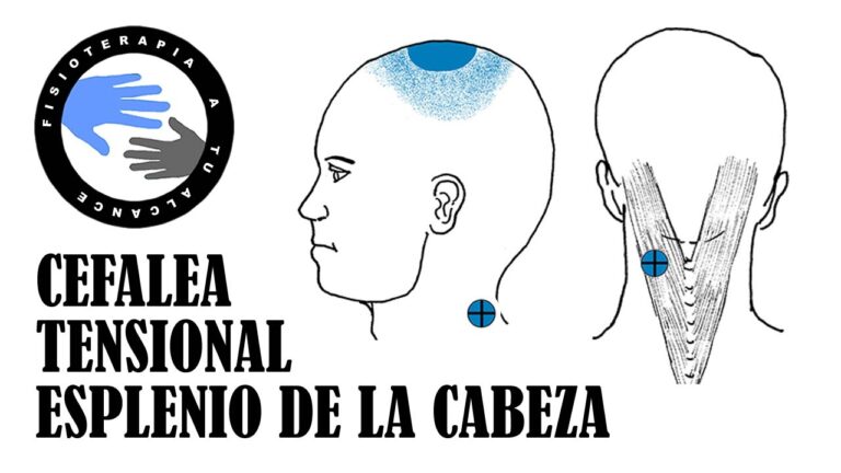 Beneficios del Masaje en el Tratamiento de Migra&ntilde;as